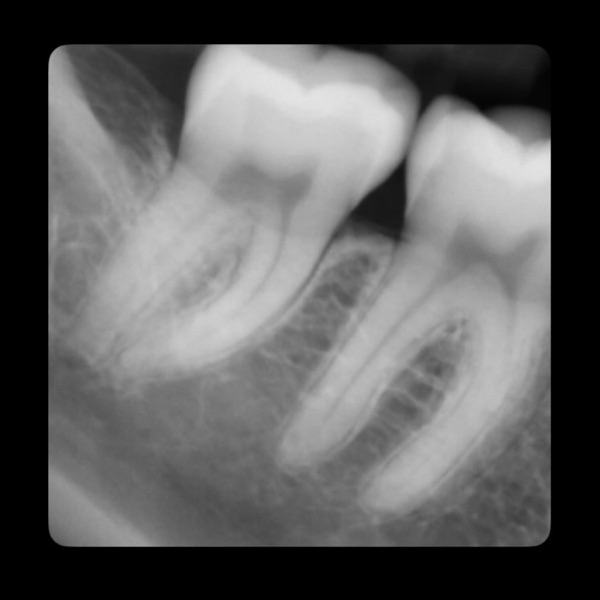 Teeth - Single album cover